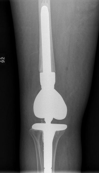 Distal Femur Replacement 3